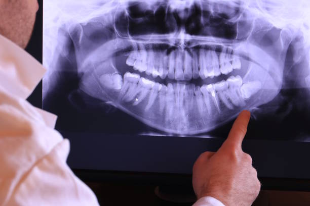 Best Knocked-Out Tooth (Avulsed Tooth) Treatment in Vista Center, NJ
